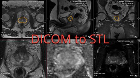 Converting DICOM to STL: A Comprehensive Guide to Methods .